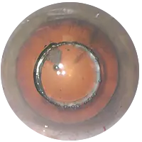 3 POINTS CLES_capsulotomie