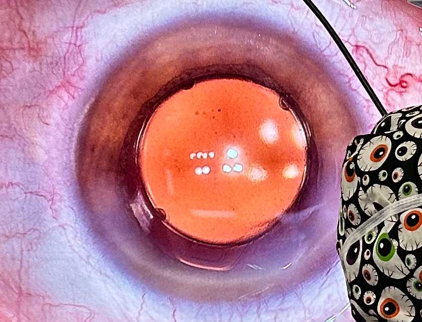 Femtis IOL implented with Rx Helix Surgical